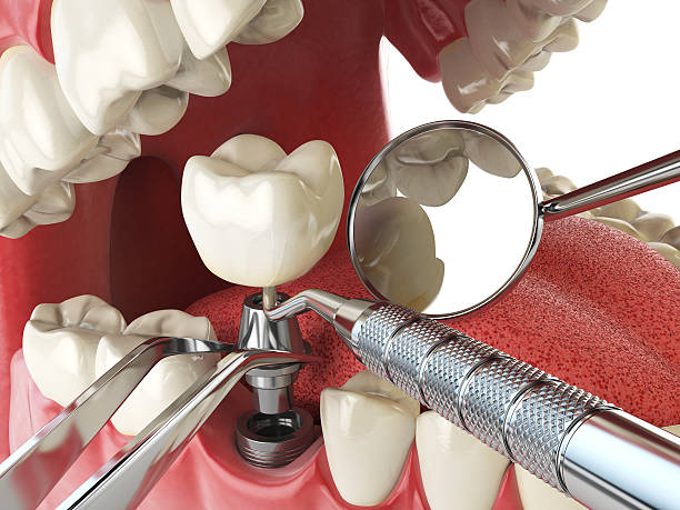 Best Urgent Tooth Repair  in Parshall, ND